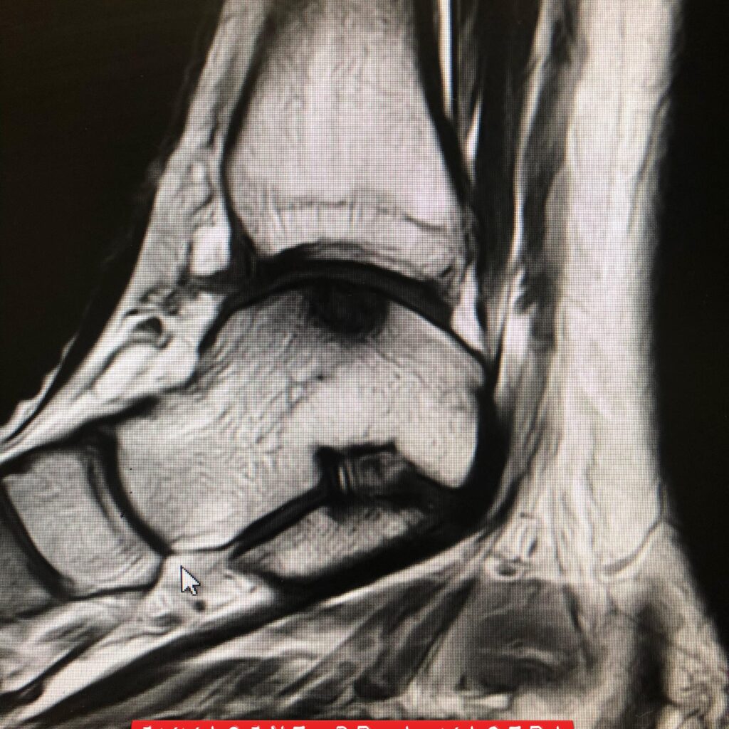 Lesione Osteocondrale Dott. Armando Macera